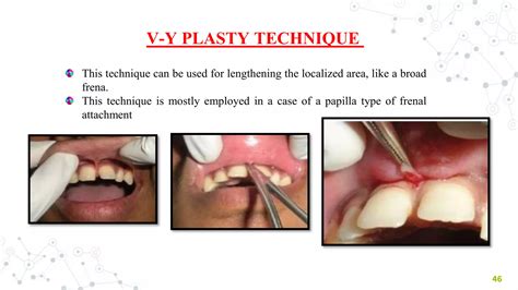 FRENAL ATTACHMENT & ITS MANAGEMENT | PPT