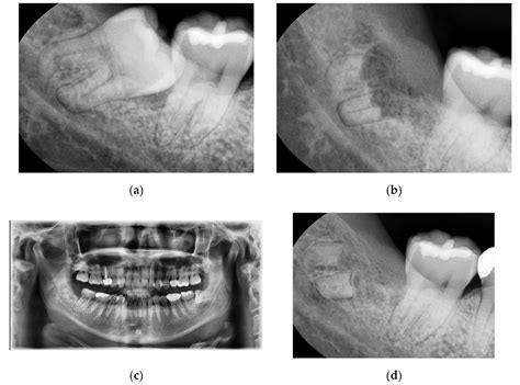 Coronectomy of Mandibular Third Molar: Four Years of Follow-Up of 130 Cases