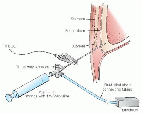 Pericardial Interventions: Pericardiocentesis, Balloon Pericardiotomy, and Epicardial Approach ...