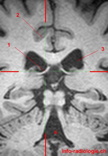 Fornix of the Brain - W-Radiology