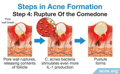 Exactly How Does Acne Form Now That Scientists Believe It Is Primarily ...