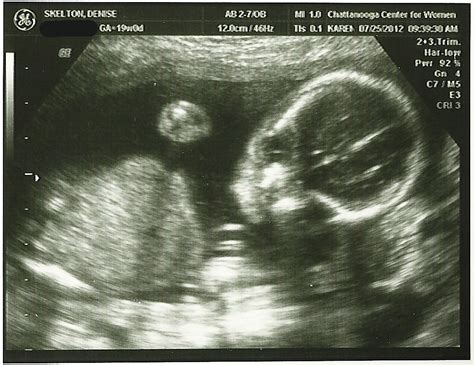 Arrows in Our Hand: 19 Week Ultrasound