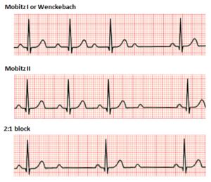 Second-degree atrioventricular block - Wikipedia