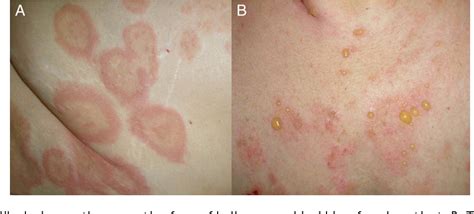 Bullous Pemphigoid Lesions