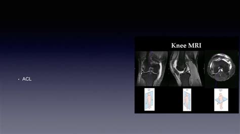 Knee ligament injury mri scan | PPT