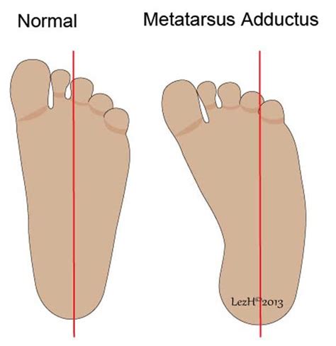 metatarsus adductus - USA News Collections