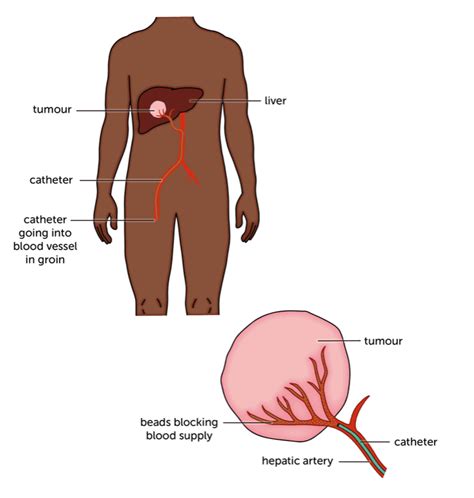 Embolization, TACE and TARE or SIRT - Liver Cancer UK