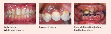 Dental pulp infection causes | National Dental Centre Singapore