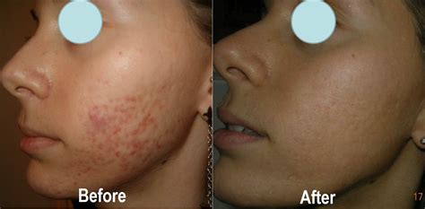 Acne Peels - Professional Salicylic Acid Peels in Chesterfield