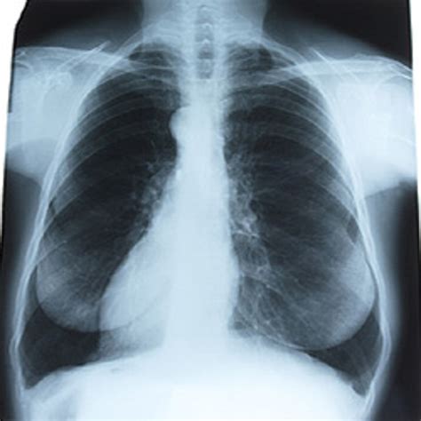 Pleurisy In Chest X-Ray: Various Radiographs To Show And Depict This Respiratory Disorder | hubpages