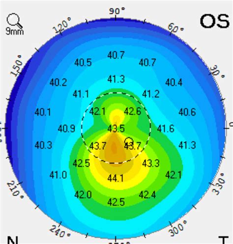 Keratoconus and Possible Treatments | CollaborativeEYE