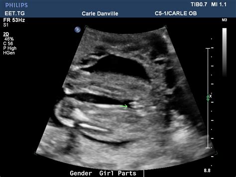 20 Week Ultrasound - Girl? TURTLE - Opinion Plz? | BabyCenter