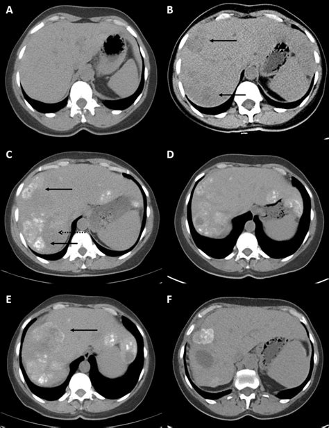 Radiological progression of liver metastases, by unenhanced CT. a... | Download Scientific Diagram