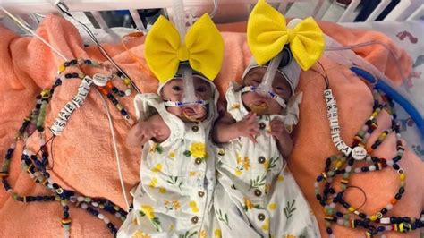 Woman gives birth to identical twins 3 days apart, doctor says it's ...