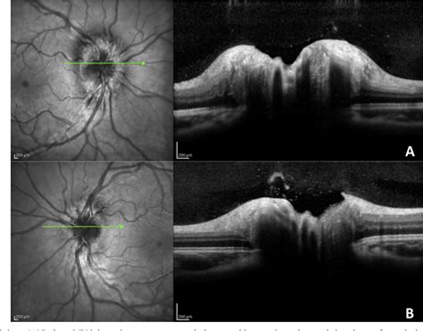 Figure 1 from Differentiating mild papilledema and buried optic nerve head drusen using spectral ...