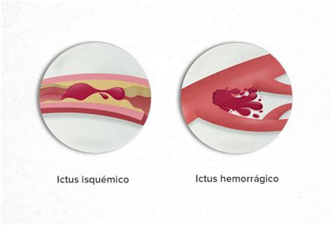 Ictus | ¿Qué es un ictus? | Infarto Cerebral | PortalCLÍNIC