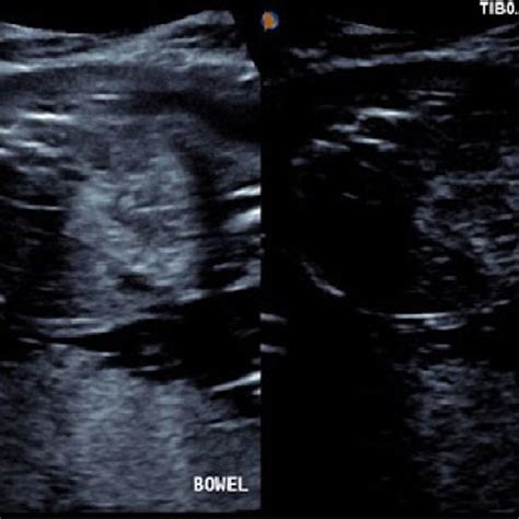 Trans-abdominal US Image Showing Fetal Echogenic Bowel. | Download Scientific Diagram