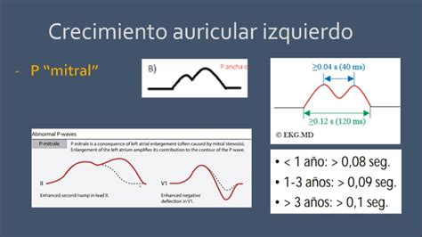 Crecimientos auriculares en el electrocardiograma | Onda P "Pulmonar" | Onda P "Mitral" - YouTube