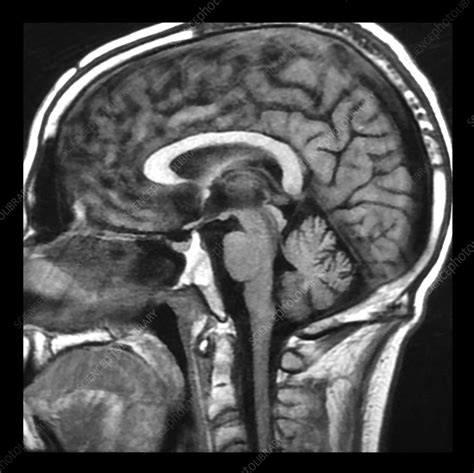 Wernicke's Encephalopathy on MRI - Stock Image - C043/0256 - Science Photo Library