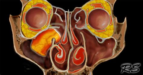 The Radiology Assistant : MRI of the Paranasal Sinuses