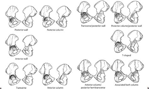 Acetabular Fractures | Radiology Key