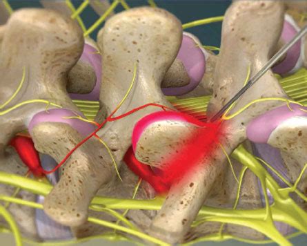 Facet Denervation Procedure | Pinched Nerve Treatment | PPOA