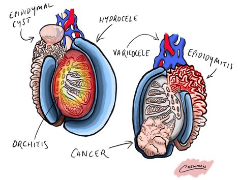 Epididymal Cyst