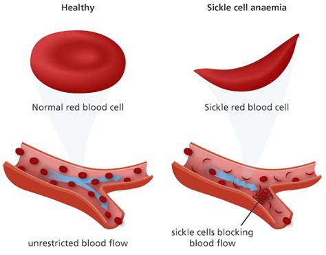 Sickle cell anemia, causes, fenetics, symptoms, diagnosis, treatment & prognosis