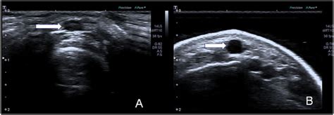 Ultrasound images of the cephalic vein (arrow) displayed via two... | Download Scientific Diagram