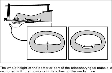 Endoscopic cricopharyngeal myotomy: indications and techniqu ...