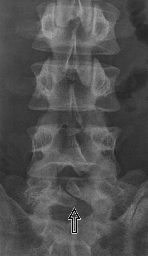 Spondylolysis X Ray