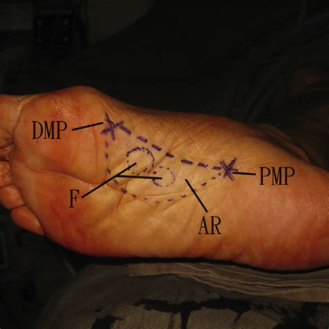 Endoscopic subtotal fasciectomy of the right foot. (A) The plantar... | Download Scientific Diagram