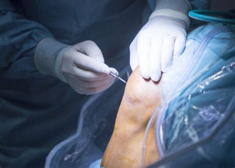 4 Types of Knee Surgery and What to Expect Before, During, and After ...