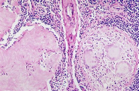 Sarcoidosis - Fibrosis of granulomas | When sarcoid granulom… | Flickr