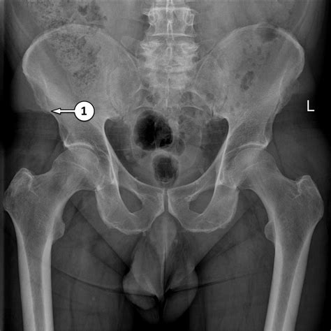 Pelvic X Ray Anatomy