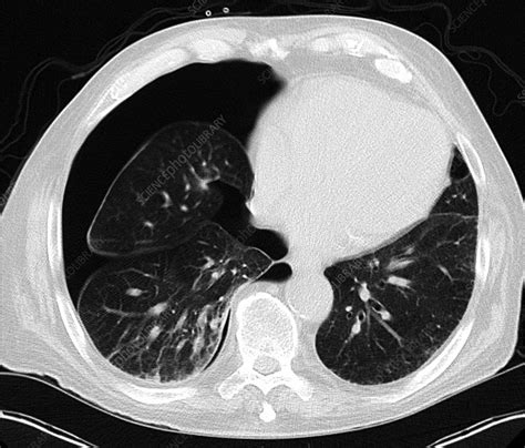 CT axial tension pneumothorax - Stock Image C036/6390 - Science Photo Library