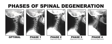 Moore Chiropractic | Spinal Degeneration in Moore