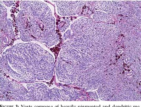 Blue Nevus Histology