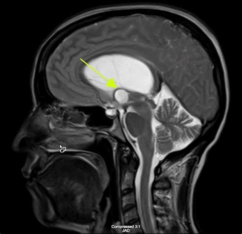 Colloid Cyst at the Foramen of Monro Leading to Symptomatic Obstructive ...