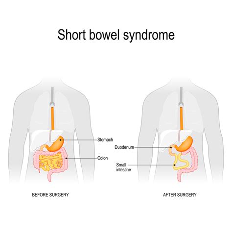 What is Short Bowel Syndrome: Everything You Need To Know - GI Associates