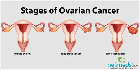 Ovarian Cancer: Causes, Symptoms, And Treatment