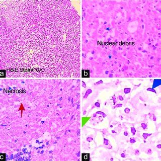 Histological examination of axillary lymph node core biopsy. Right ...