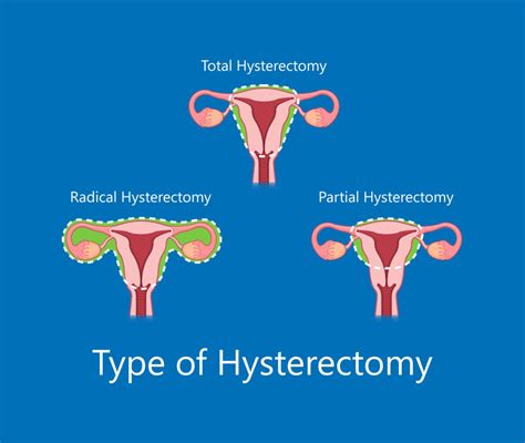 Myomectomy vs. Hysterectomy: Which is Right for You? | New York City ...