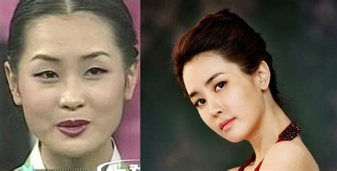 Korean Before and After Plastic Surgery Pictures of Celebrities: Still a Big Deal? - Seoul ...