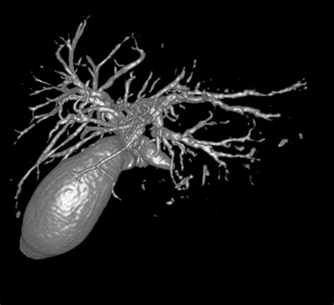 Gallbladder And Biliary Tree, 3d Mri Photograph by Du Cane Medical Imaging Ltd