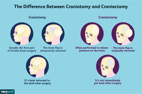 Craniectomy: Procedure, Risks, and Recovery Time