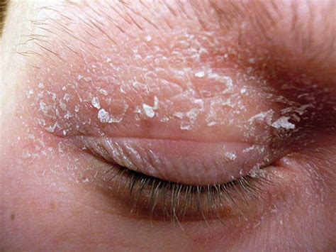 👉 Flaky Skin - Symptoms, Treatment, Causes, Pictures (February 2022)