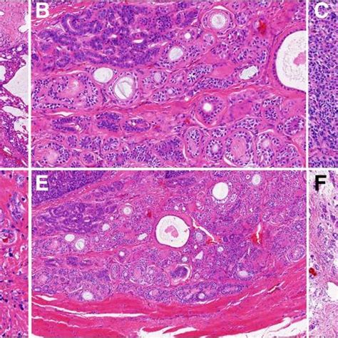 Histology of Bartholin's gland adenoid cycstic carcinomas (Hematoxylin ...