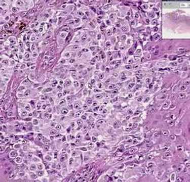 Histopathology Skin --Malignant melanom - YouTube