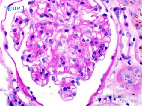 Hemosiderosis | Teaching Point | Arkana Laboratories